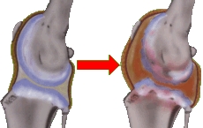 Osteoarthritis